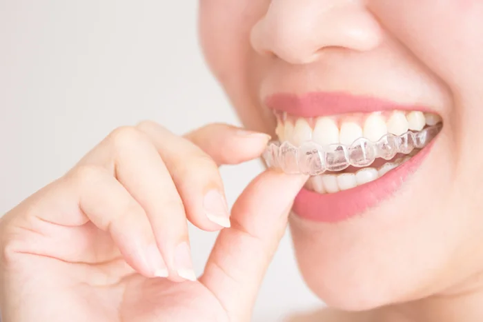 Clear Aligner