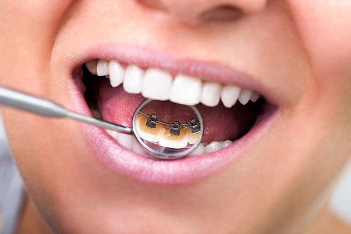 Lingual Braces