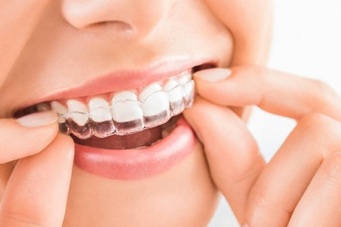Braces
