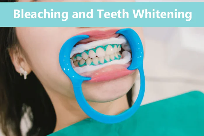 Bleaching and Teeth Whitening