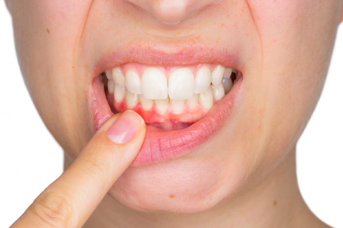 Gum Surgery