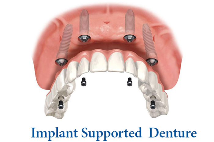 Denture