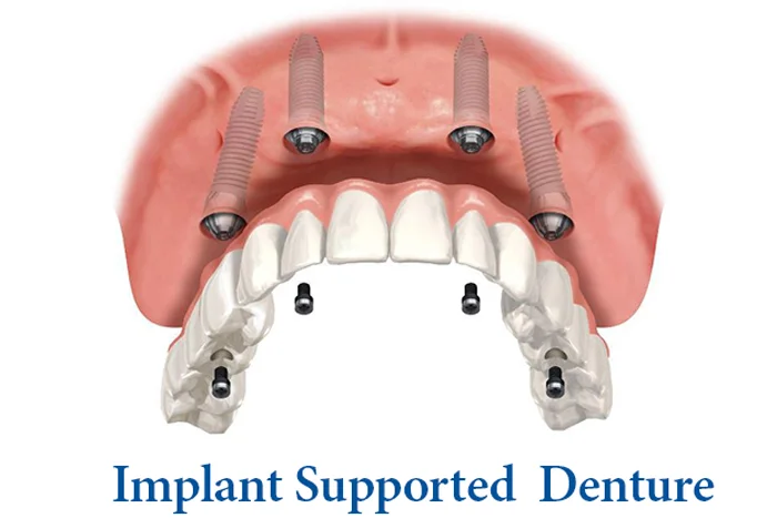 Denture