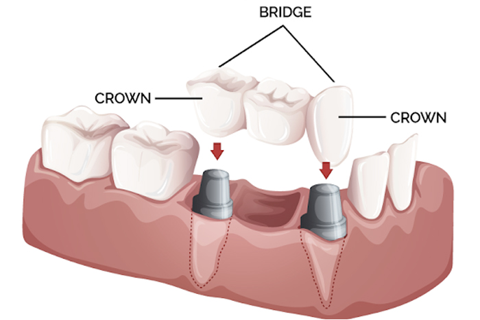 Crowns and Bridges