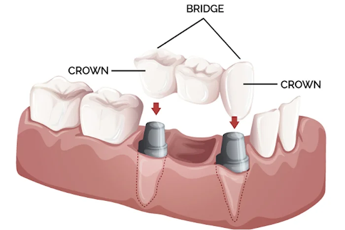 Crowns and Bridges