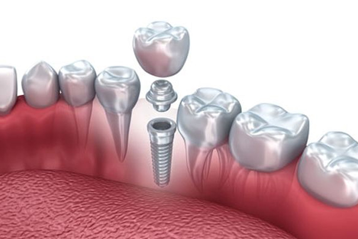 Implant