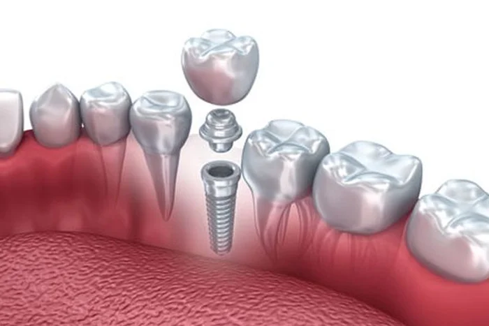 Implant
