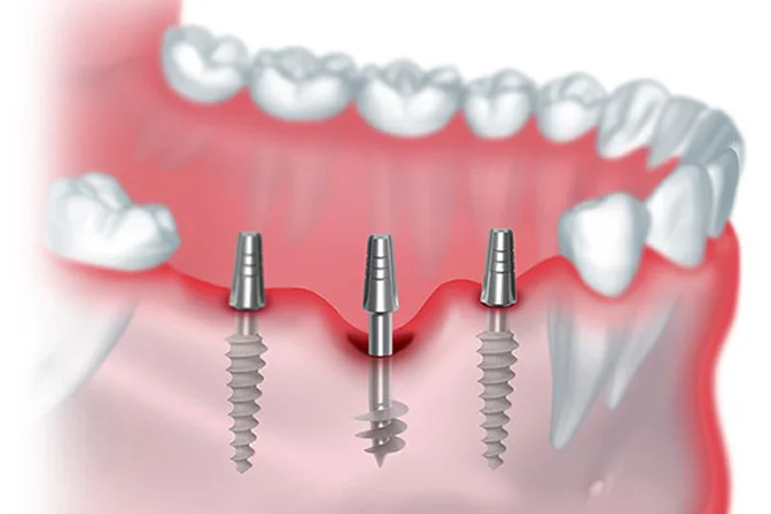 Basal Implant