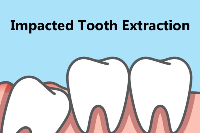 Impacted Tooth Extraction