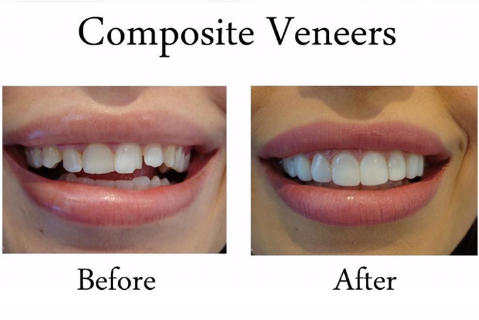 Composite Veneers