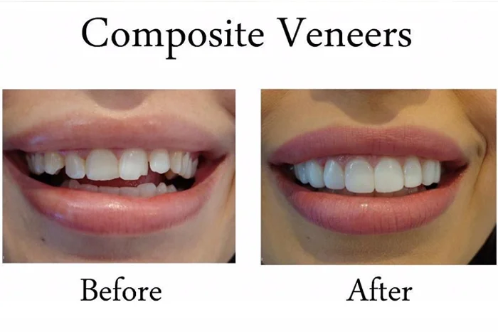 Composite Veneers