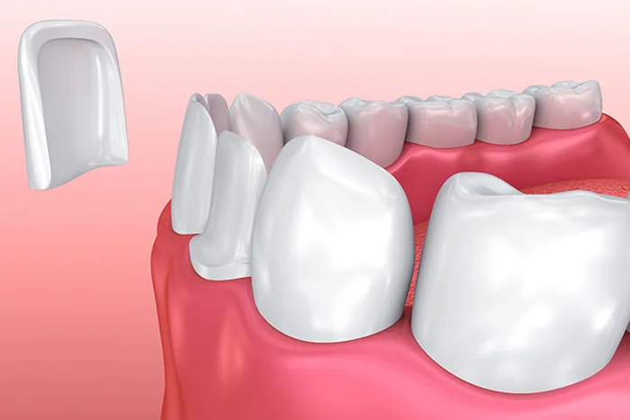 Ceramic Veneers