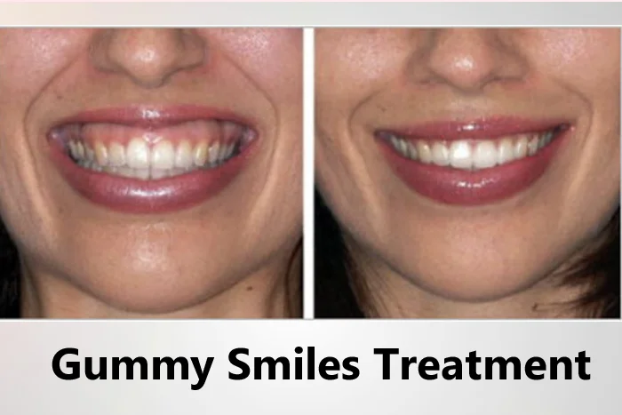 Smile Designing