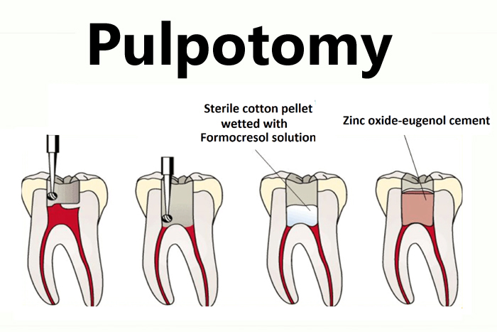 Pulpotomy