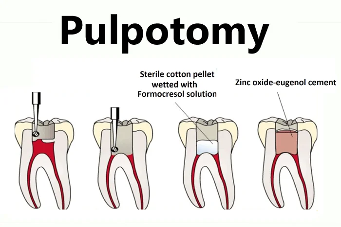 Pulpotomy